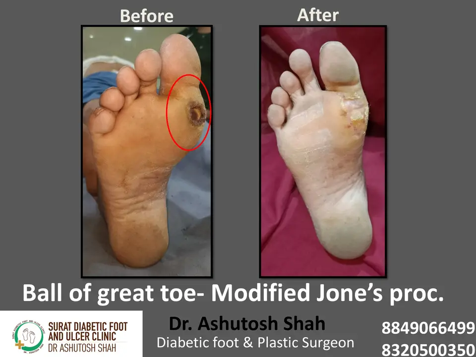 Diabetic Foot  PPT 3 checked by sir.pptx-43.webp